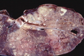 Gambar Penyakit TBC (tuberculosis)