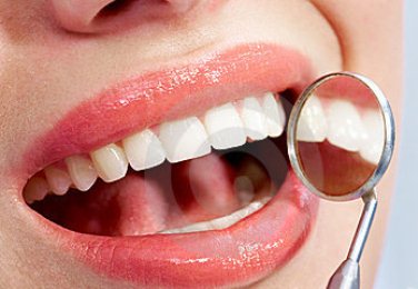 6 Cara menghilangkan Karies atau Karang Gigi
