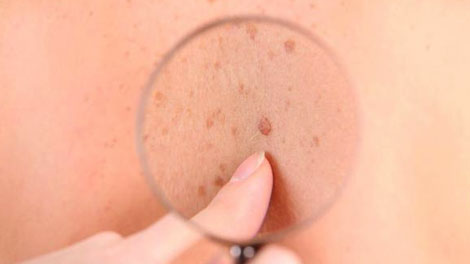 Kanker Kulit - www.merdeka.com