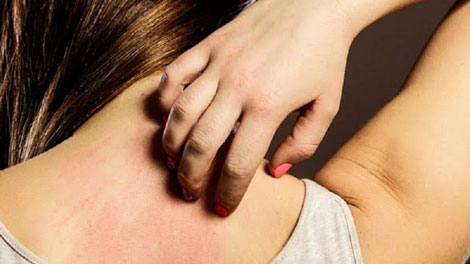 Kulit Terasa Gatal - lifestyle.okezone.com