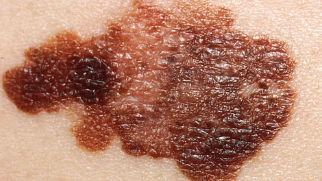 Melanoma - en.wikipedia.org