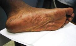 Plantar rash Plantar rash
