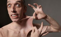 Ehlers-Danlos-Syndrome Ehlers-Danlos-Syndrome