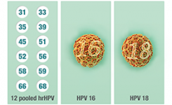 HPV penyebab kanker serviks