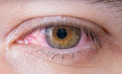Infeksi Herpes pada Kornea