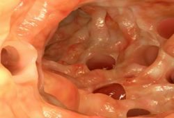 Tentang Leaky Gut (Kebocoran Usus) dan Penyebabnya