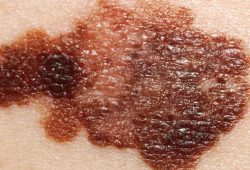 Tahi Lalat Berisiko Kembangkan Melanoma?