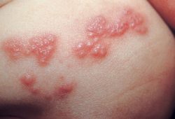 Tentang Sinanaga (Herpes Zoster), Gejala dan Pengobatan