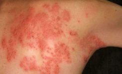 herpes-kulit herpes-kulit