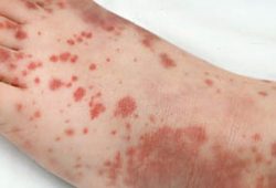 Terapi Obat-obatan Medis untuk Mengobati Sakit ITP