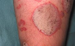 penderita-psoriasis