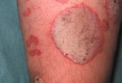 Terapi Pengobatan Medis untuk Penderita Psoriasis