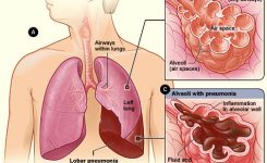pneumonia-wikipedia